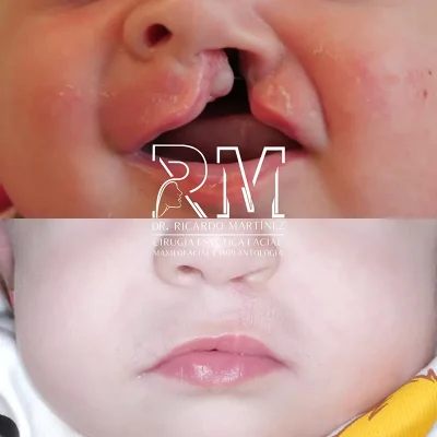 Boca_bebe Cirugia estética