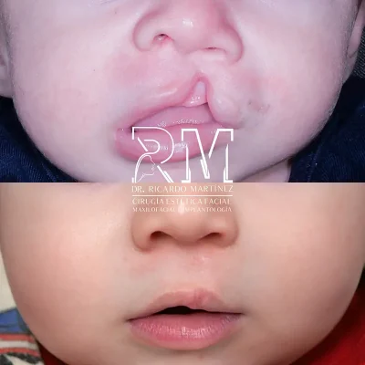 Boca_bebe2 Cirugia estética