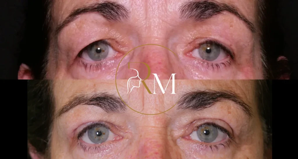 Blefaroplastia superior, antes y después en vista frontal, mirada descansada — Dr. Ricardo Martínez, Tenerife