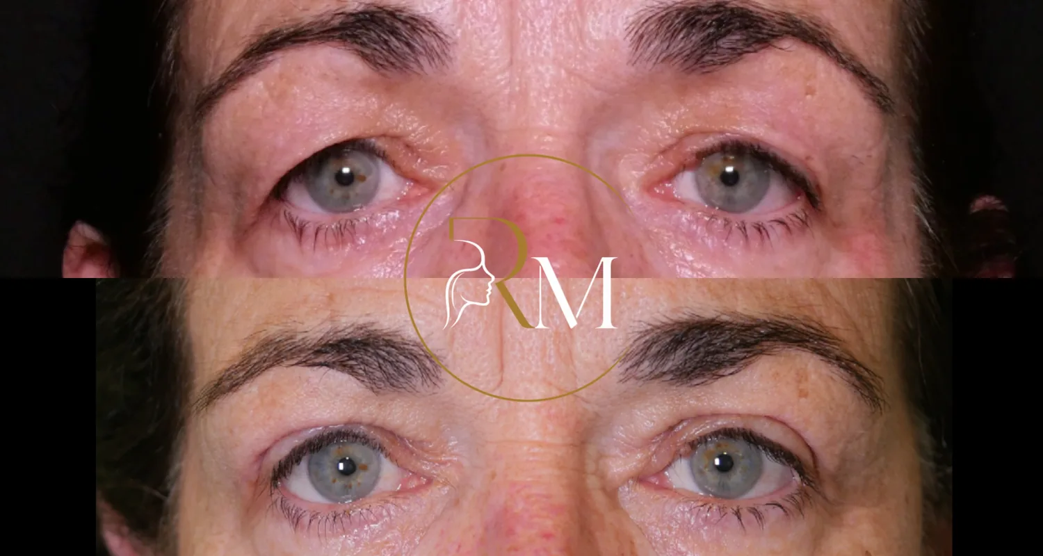 Blefaroplastia superior, antes y después en vista frontal, mirada descansada — Dr. Ricardo Martínez, Tenerife