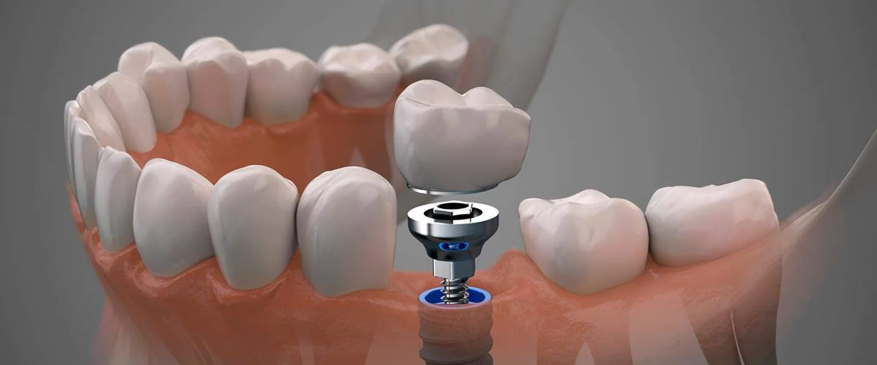 Implantología. Dr. Ricardo Martínez