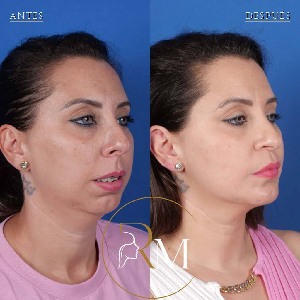 Preoperatorio