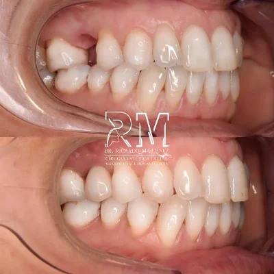 implantes Implantes