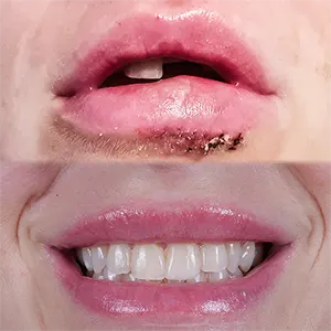 labios1 Implantes