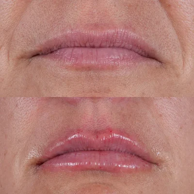 labios2 Labios caso2