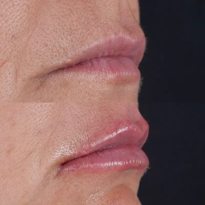 labios3 Labios caso1