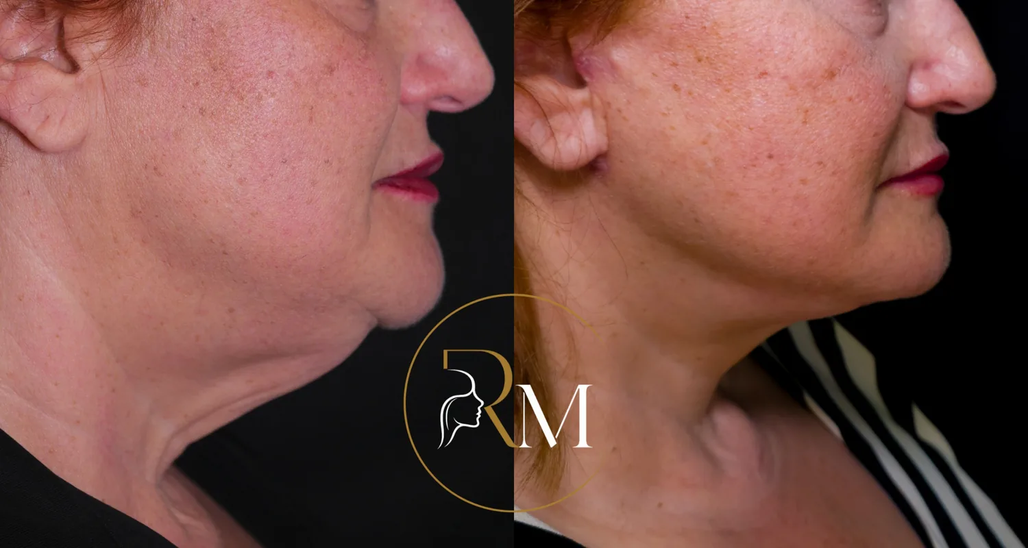 Lifting facial deep plane Tenerife, antes y después de perfil — Dr. Ricardo Martínez