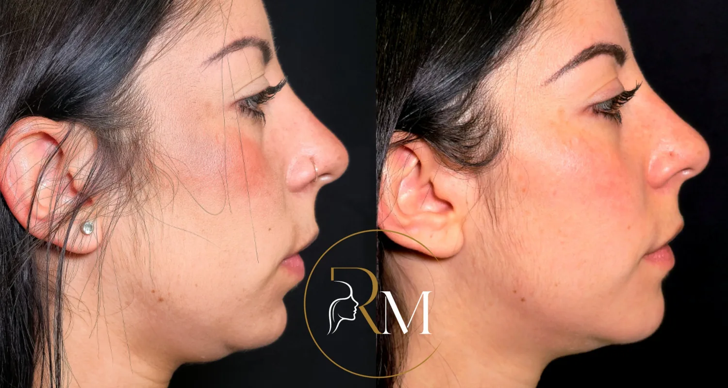 Mentoplastia de avance, antes y después de perfil, mejora del mentón y la línea cuello-mentón — Dr. Ricardo Martínez, Tenerife