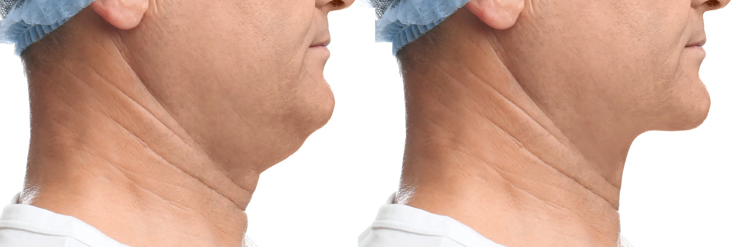 Mentoplastia y lipopapada