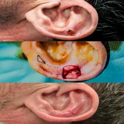 oreja Cirugía tumor