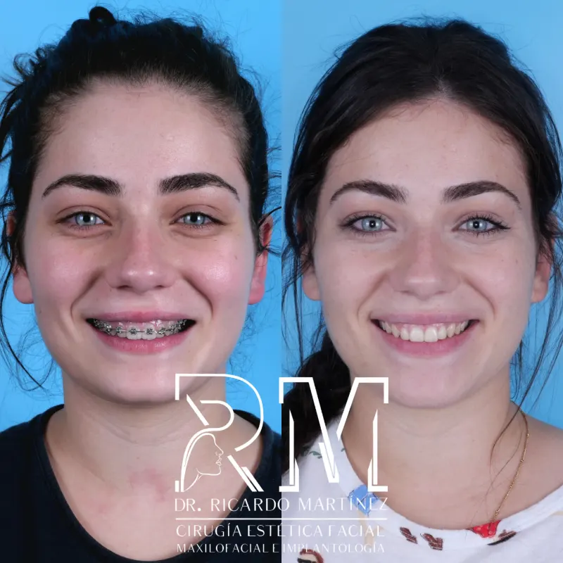 Cirugía ortognática-caso