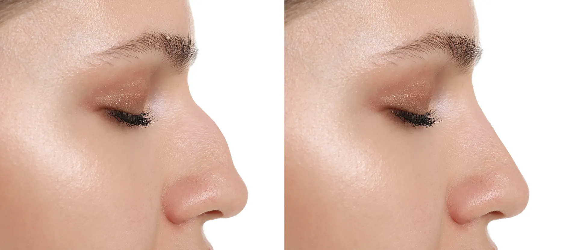 Rinoplastia ultrasónica