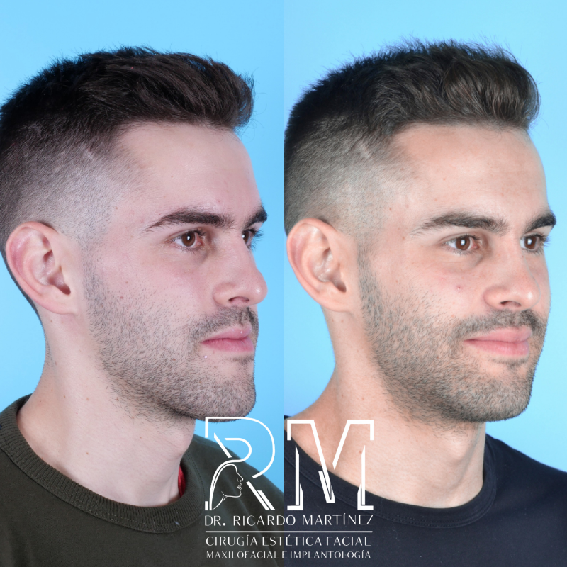 Cirugía ortognática-caso1